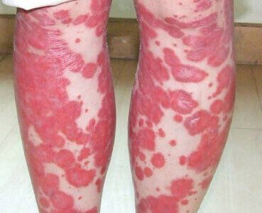 Erythrodermic Psoriasis