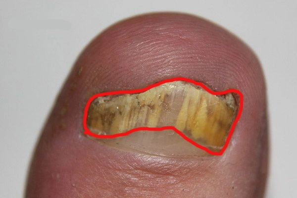 onychomycosis