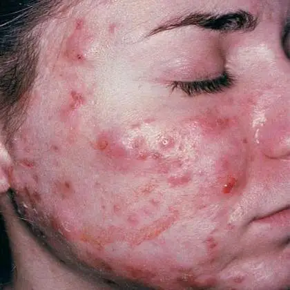 Nodular Cystic Acne