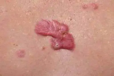 Proliferative scarring