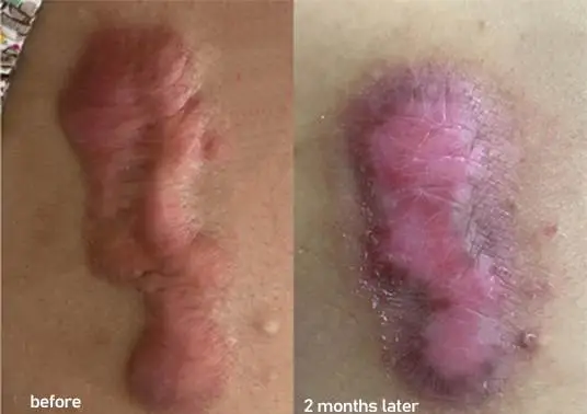 Proliferative scarring