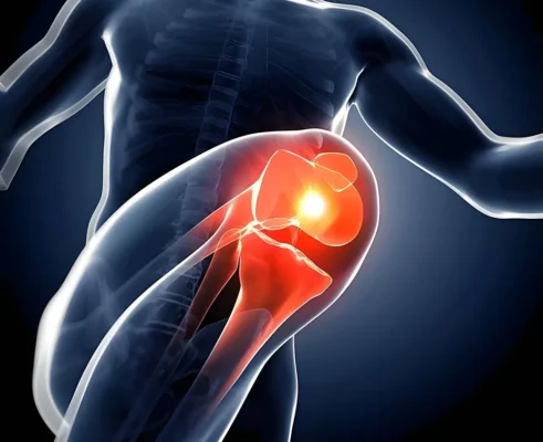 Tricompartmental-Osteoarthriti