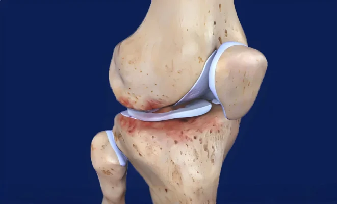 Tricompartmental Osteoarthritis