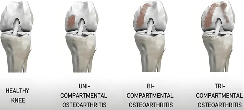tricompartmental-osteoarthritis