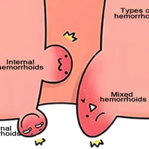 Types of hemorrhoids