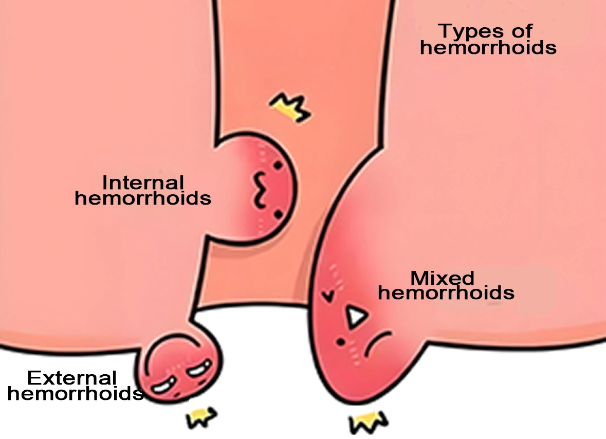 Types of hemorrhoids