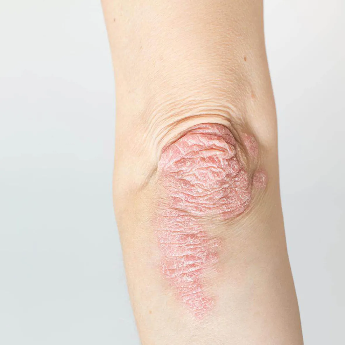 Psoriasis