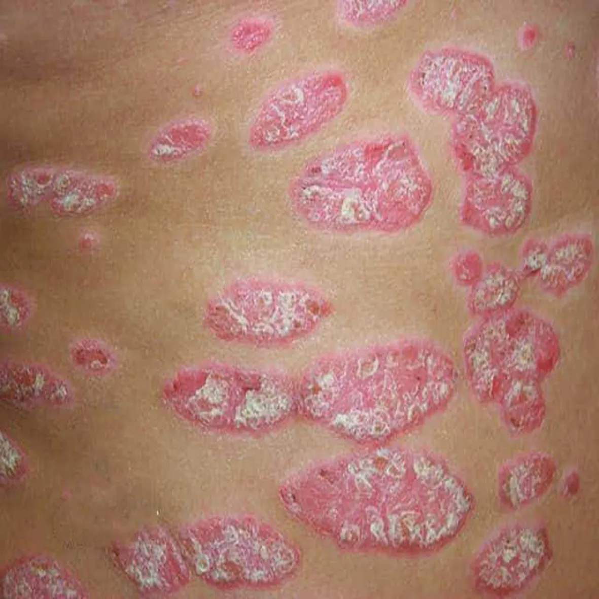 Psoriasis