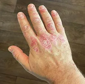 Hand psoriasis