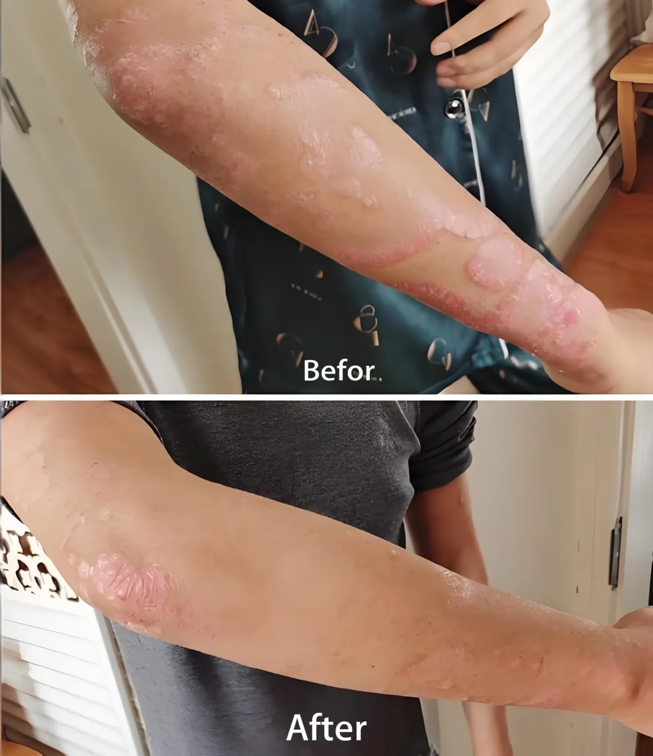 psoriasis